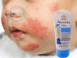 kem-tri-cham-cho-be-aveeno-baby-eczema-therapy-cua-my-141g7